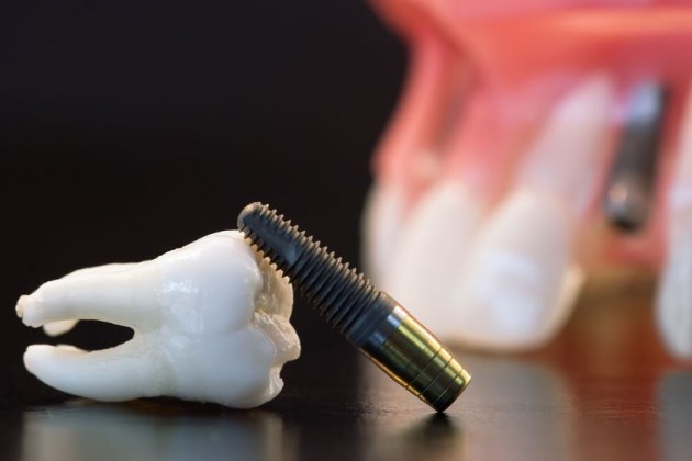 Dental Implants : smiles dental care